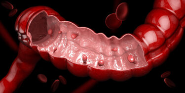 大腸ポリープを予防するのに今マグネシウムが注目されている？