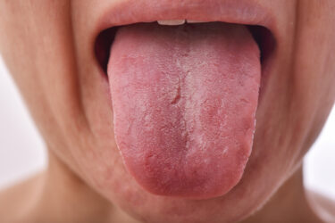 舌癌を予防するのに今マグネシウムが注目されている？