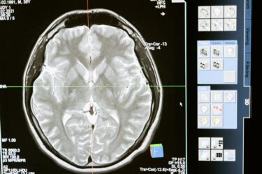 脳腫瘍を予防するのに今マグネシウムが注目されている？